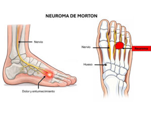 ¿Qué es el Neuroma de Morton?