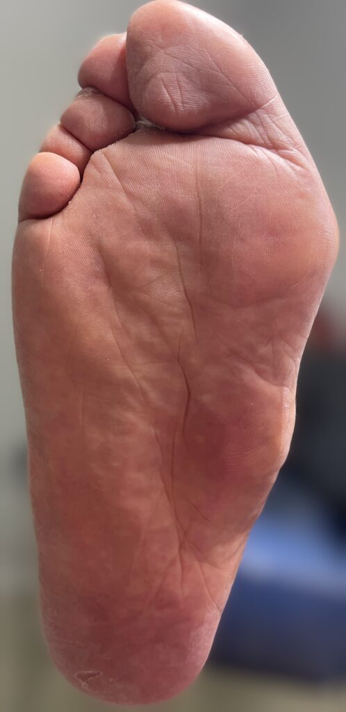 Pie de charcot