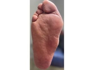 Pie de Charcot