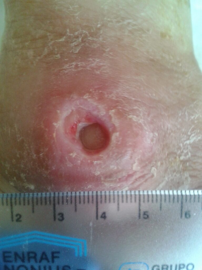 Pie Diabético