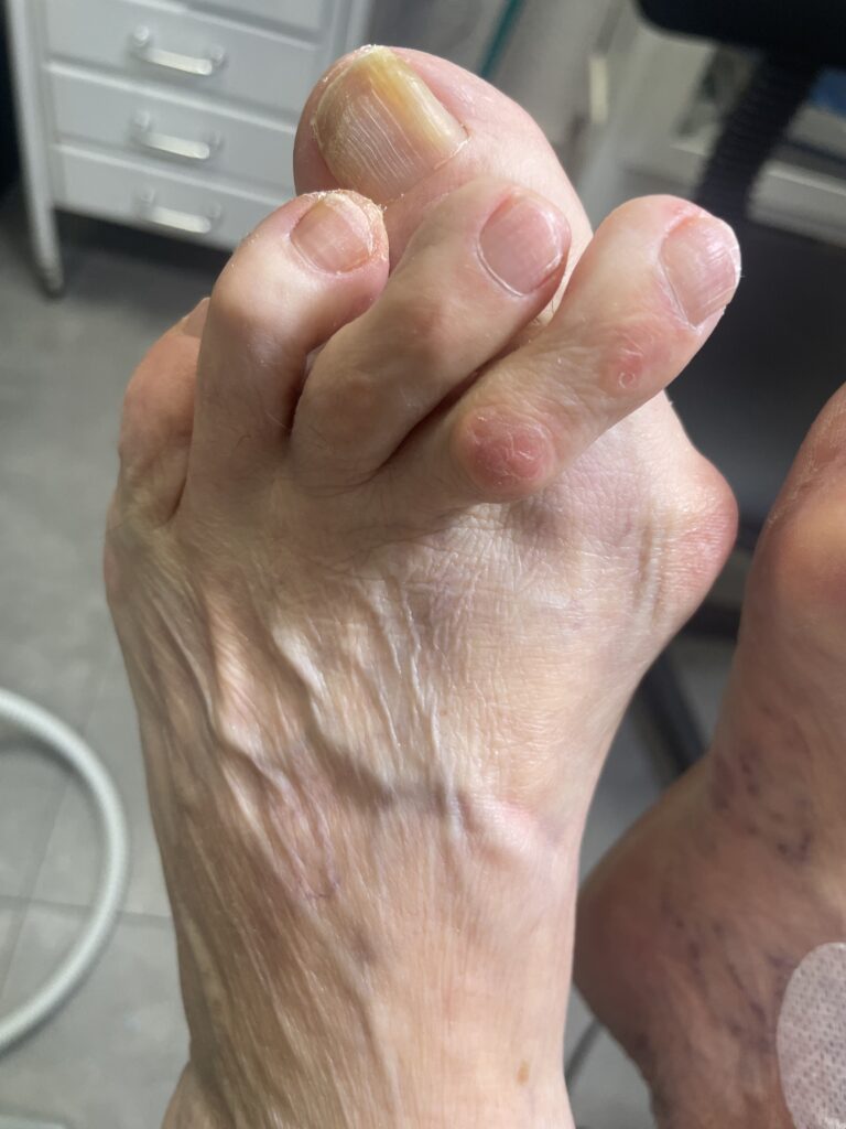 Hallux Valgus (juanete)