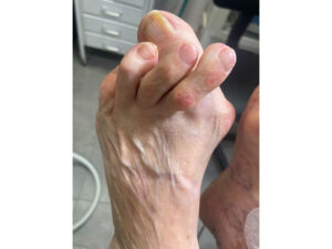 Hallux Valgus (juanete)